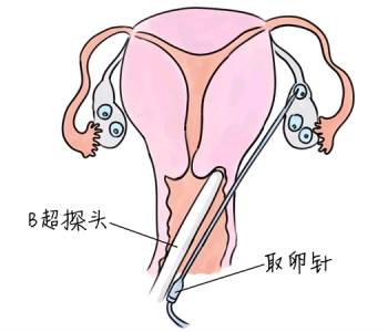 小儿退烧推拿手法 5种长沙捐卵宝宝退烧按摩方法